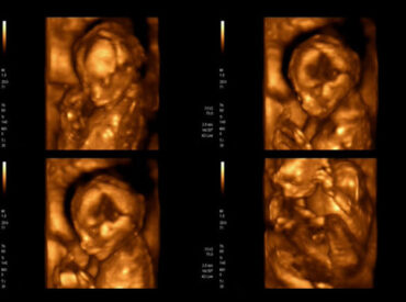 4d-baby-scan-chennai
